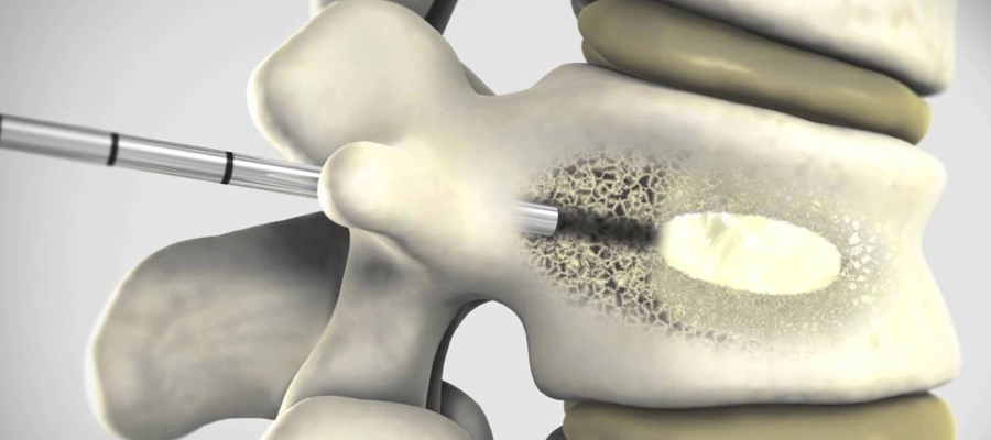 vertebroplasty