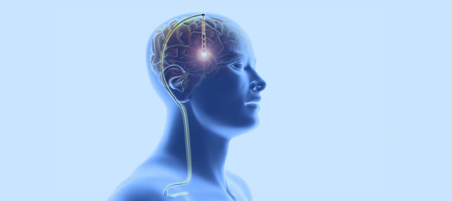 beyin-pili-ameliyati