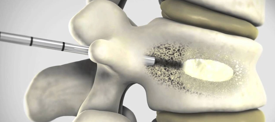 vertebroplasty